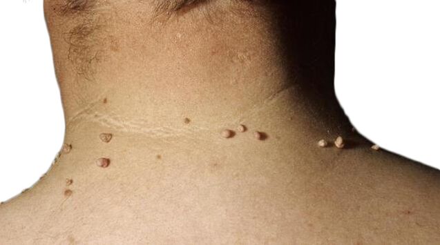 Papillomi sul collo - una conseguenza della sconfitta del virus