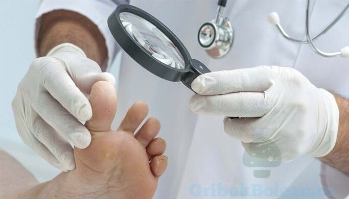 diagnosi di fungo del piede da parte di un medico