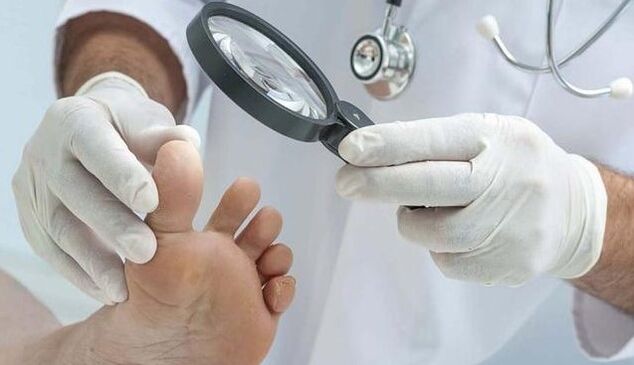 Diagnosi di funghi