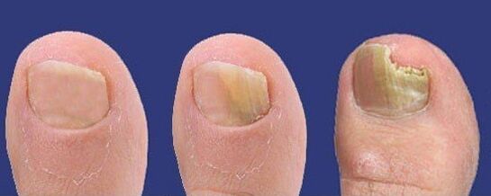 Sviluppo del fungo dell'unghia del piede
