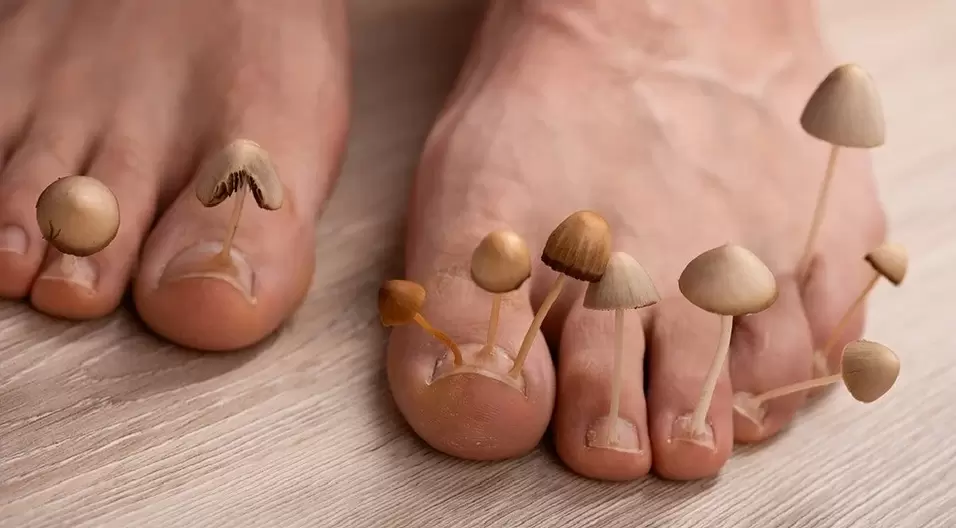 Infezione fungina che colpisce le unghie dei piedi