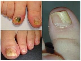Aspetto delle unghie dei piedi con onicomicosi