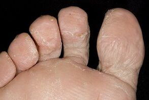 La pelle dei piedi con un'infezione fungina