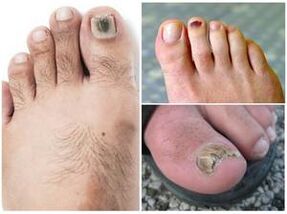 Segni di un'infezione fungina dell'unghia del piede