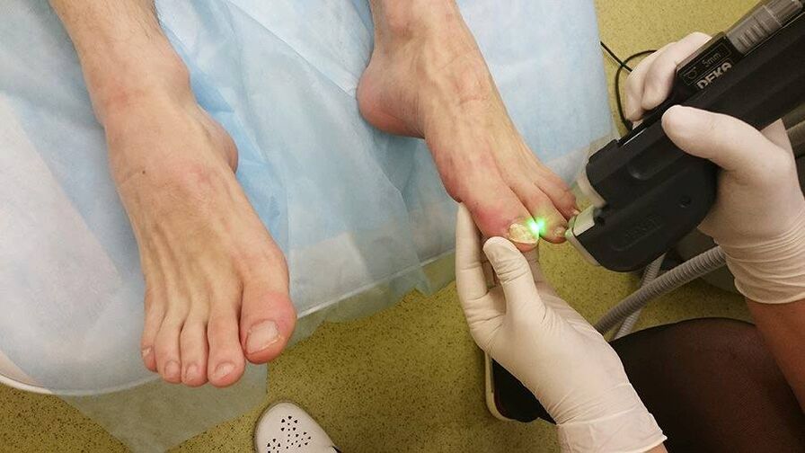 Trattamento laser per funghi alle unghie dei piedi