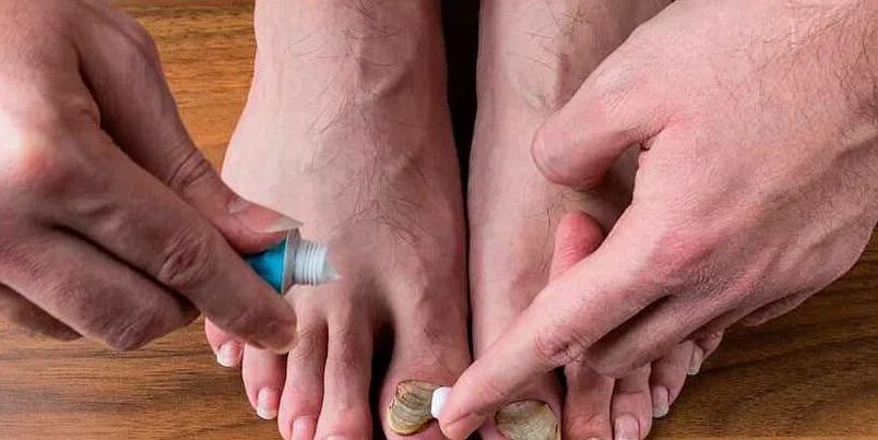 Cause dei funghi tra le dita dei piedi