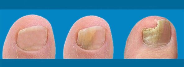 Lo sviluppo dell'onicomicosi - fungo dell'unghia del piede