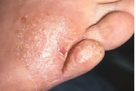 Manifestazioni di un'infezione fungina sulla pelle del piede